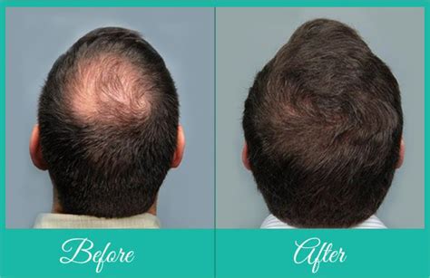Best Hair Transplant Return Your Young Look With Crown Hair Restoration