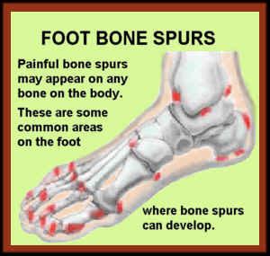 Heel bone spurs are a common problem resulting in pain either behind or underneath the heel. ARTICLE # 377 Bone Spurs - Almawi Limited The Holistic Clinic