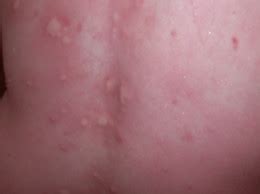 Hives that start within minutes or hours after contact. Hives, Rashes, and Allergies OH MY!