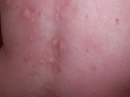 The reason why your dog eats grass, is because they may have a upset stomach. Hives, Rashes, and Allergies OH MY!
