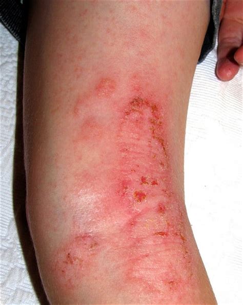 Eczema Causes Symptoms Treatment Online Homework Help