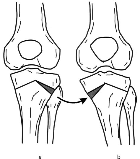 Inverted V Shaped High Tibial Osteotomy Compared With Closing Wedge