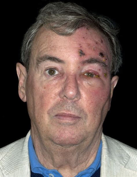 Symptoms generally include a rash of the forehead with swelling of the eyelid. Persistent dilemmas in zoster eye disease | British Journal of Ophthalmology