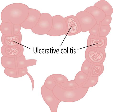 Ulcerative Colitis Causes And Symptoms