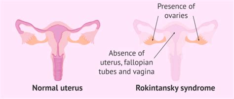 Absent Uterus What Is Mayer Rokitansky Küster Hauser Syndrome