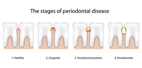 Brooklyn Ny Gum Disease Stages Gingivitis Periodontitis