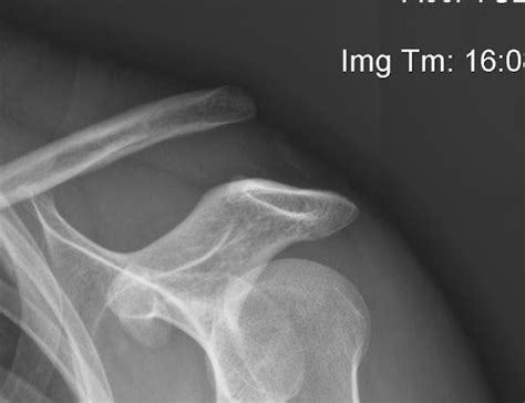 Complete separation (grades 3, 4, 5, and 6) initial symptoms. ACJ dislocation / separation : The Shoulder and Elbow Clinic