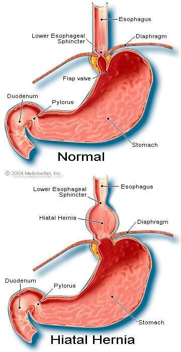 15 Hiatal Hernia Symptoms Causes Diet Treatment And Surgery