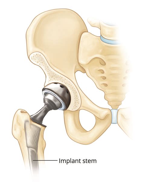 Fracture After Total Hip Replacement Orthopedic And Sports Medicine