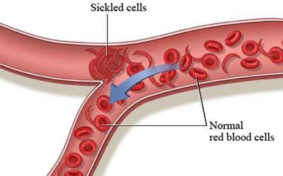 The most common form of scd found in north america is homozygous hbs disease (hbss), an autosomal recessive disorder. HELP for SICKLE-CELL DISEASE - An Ounce Of Prevention Blog
