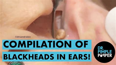 A Compilation Of Blackheads In The Ears Dr Pimple Popper