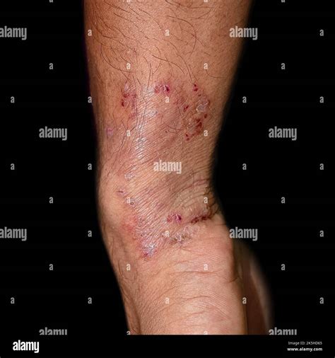 Tinea Corporis Fotografías E Imágenes De Alta Resolución Alamy