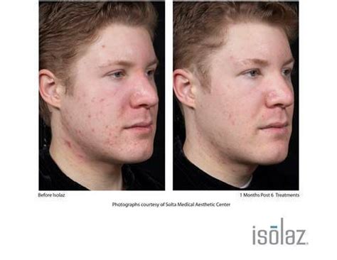 Isolaz Laser Acne Treatment Spa Cosmedica And Laser Center