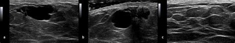 Cureus Benign Breast Cyst In A Young Male