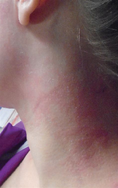 Case Report First Reported Case Of Facial Rash After Dupilumab Therapy