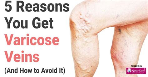 5 Reasons You Get Varicose Veins And How To Avoid It