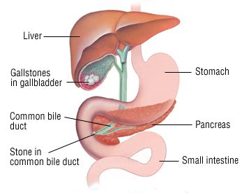 If you wait too long, it can rupture, spewing bacteria all over your innards—disgusting and life threatening. Acute Pancreatitis - Harvard Health
