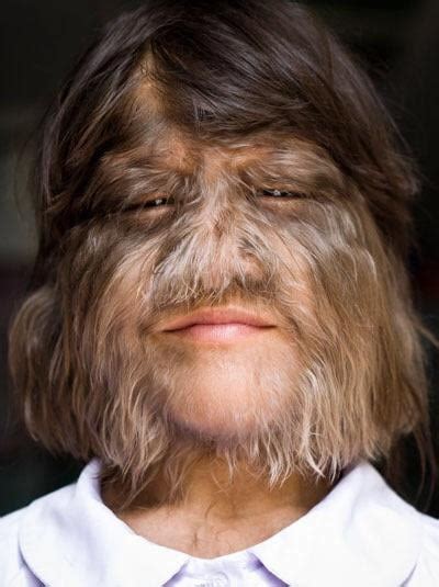 Girl With Hypertrichosis Also Known As Werewolf Syndrome 9gag