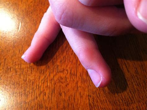 What Is This Lump On My Dds Finger Not Gross Just Odd Babycenter