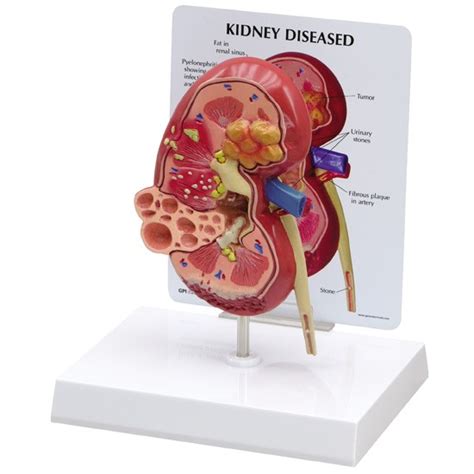 Kidney Anatomical Model Normal And Pathologies