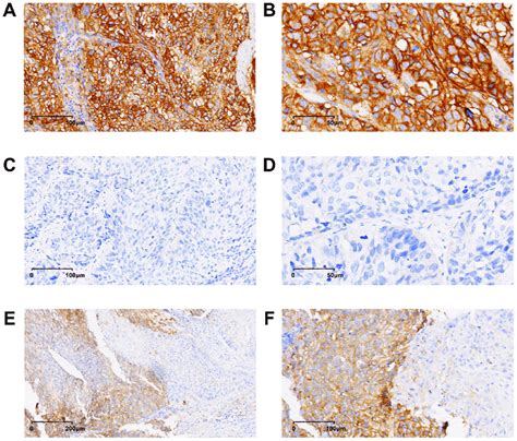 Immunohistochemical Staining Of Pd L1 In Esophageal Squamous Cell
