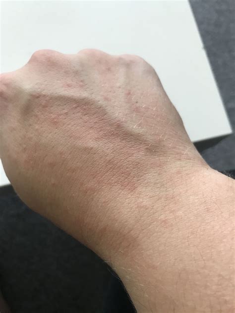 When you have eczema, your skin is inflamed and develops dry patches that flake off. Does this look like heat rash/an allergic reaction ...