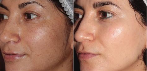 Bbl Laser Skin Rejuvenation Before And After Pictures Case