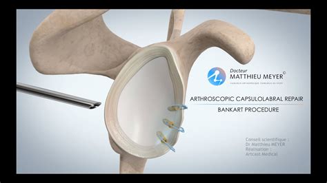 Arthroscopic Shoulder Stabilisation Bankart Procedure Dr Matthieu