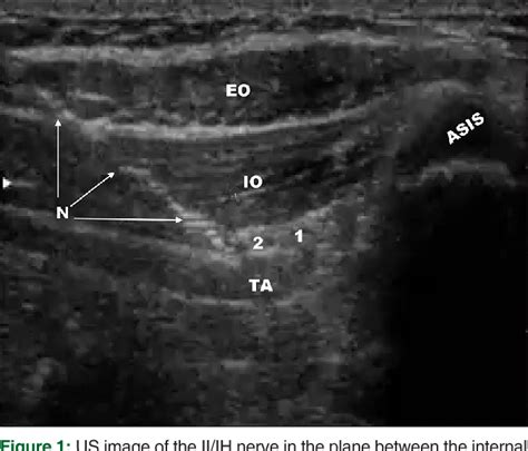 Figure 1 From Ultrasound Guided Ilioinguinaliliohypogastric Nerve