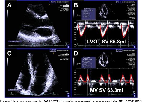 Figure From Automated Quantification Of Mitral Inflow And Aortic Outflow Stroke Volumes By