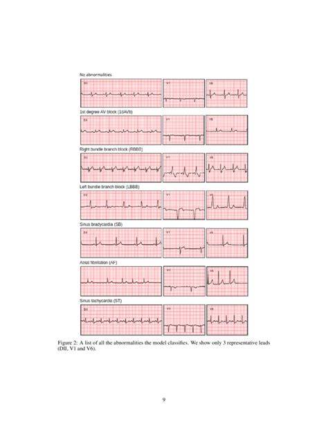 Automatic Diagnosis Of Short Duration 12 Lead Ecg Using A