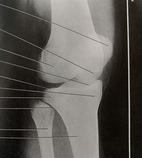 Ap Oblique Knee Diagram Quizlet