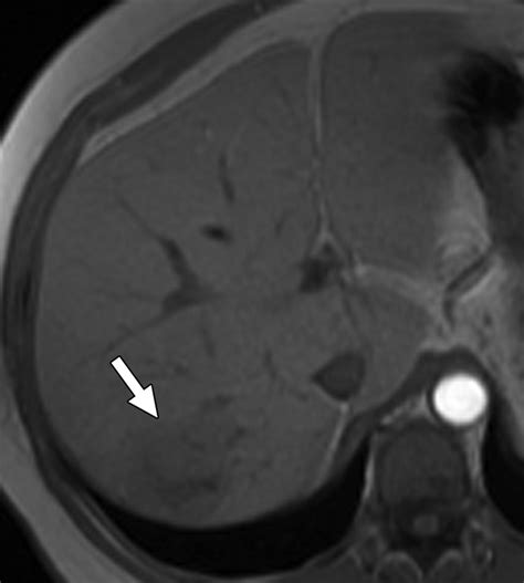 Multiple Hepatic Adenomas Associated With Liver Steatosis At CT And MRI