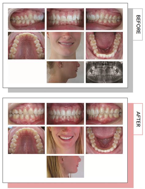 Invisalign Gallery Competition Semi Finalists Marin Ortho