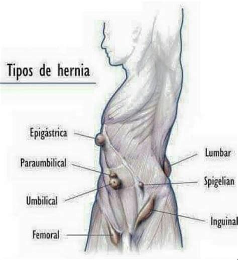 Hernia Causes Types Symptoms Locations Pictures And Treatment