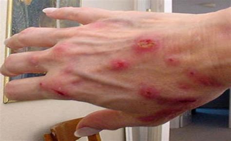 Parasite Under Skin Humans