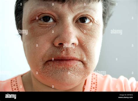 Eczema Rash On Face Treatment