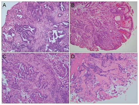 Gastric And Colonic Metastases From Primary Lung Adenocarcinoma A Case