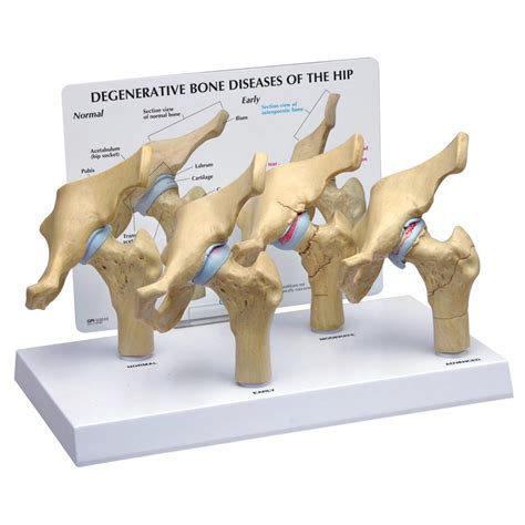 4 Stage Degenerative Bone Diseases Of The Hip Model Sem Trainers