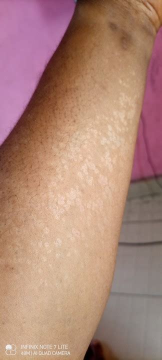 Help White Patches On My Forearm Health Nigeria