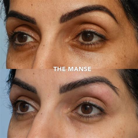 Upper Eyelid Fillers Best Clinic Sydney For Dermal Fillers