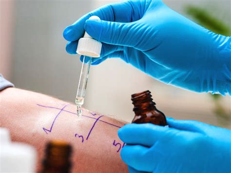 Allergy Testing Purpose Procedure And Results