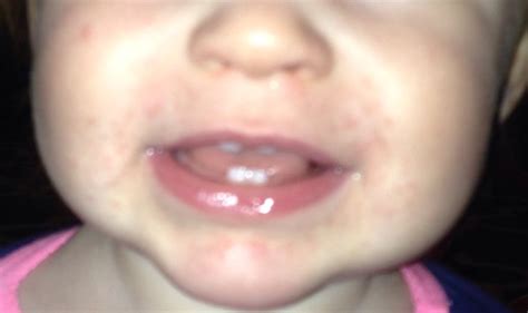 It typically causes a bright red rash on both cheeks and a fever. Mystery Rash - BabyCenter