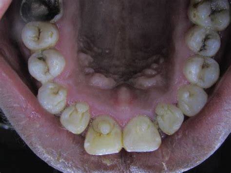 Case 3 Palatal View Shows Talon Cusps In All Upper Anterior Teeth