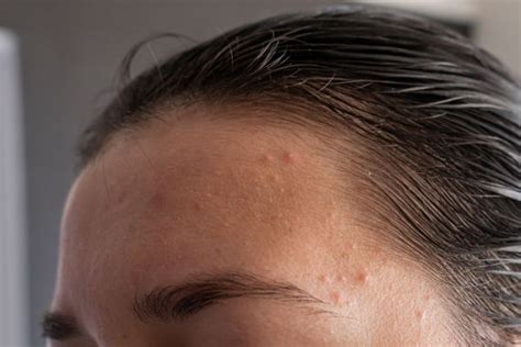The Best Way To Treat And Prevent Forehead Acne Goodglow
