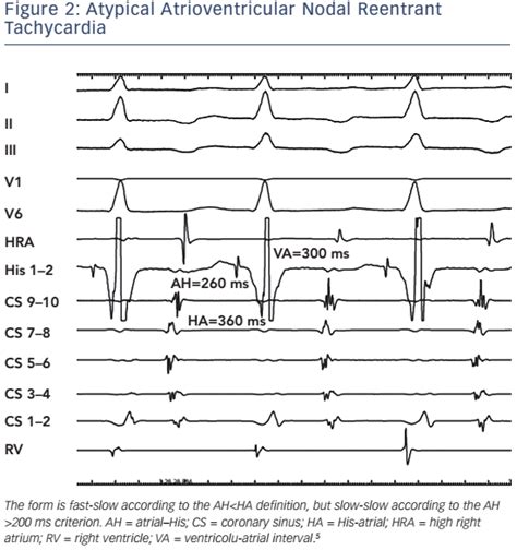Classification Electrophysiological Features And Therapy Of Atrioventricular Nodal Reentrant