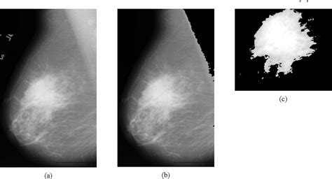 Figure From Classification Of Benign And Malignant Masses In Breast Mammograms Semantic Scholar