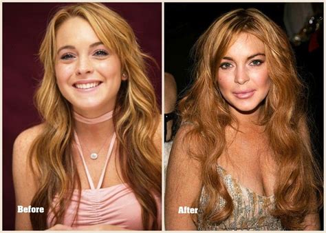 Lindsay Lohan Plastic Surgery Before And After Photo 2013 2014 Celebrity Plastic Surgery