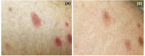 Frontiers Case Report Pityriasis Rosea Like Eruption Following Covid
