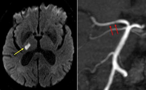 Before And After Stroke Insights Reveal Targets For Prevention